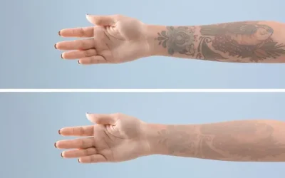 Say Goodbye to Tattoo Regrets: Guide to Removing Tattoos