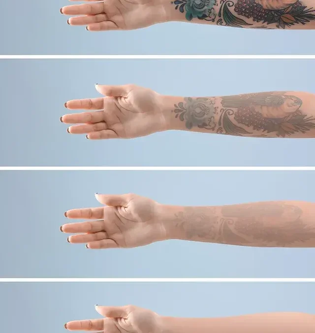 Say Goodbye to Tattoo Regrets: Guide to Removing Tattoos