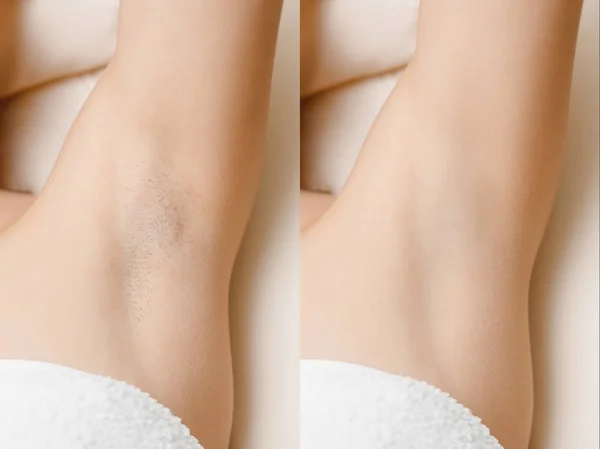 Body Laser Hair Removal 1