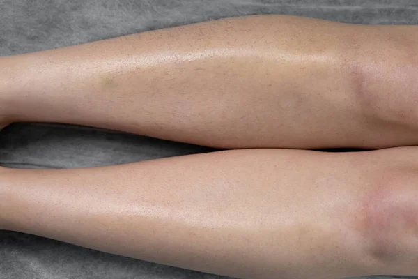 Body Laser Hair Removal 2
