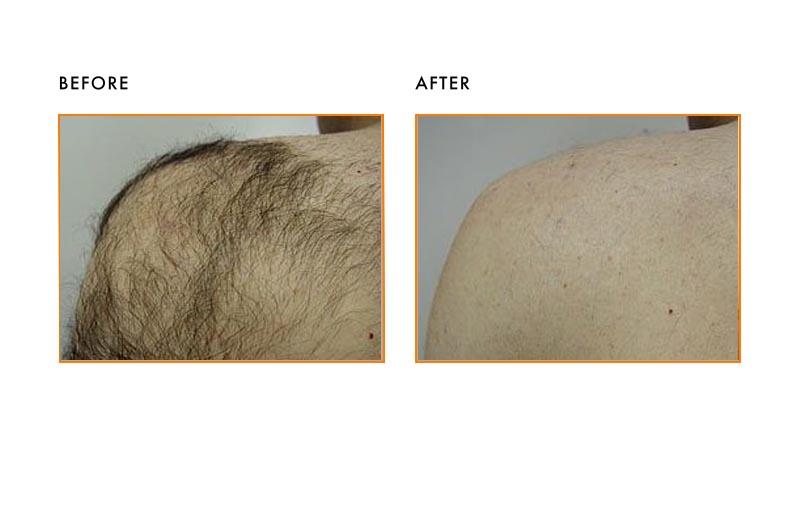 Body Laser Hair Removal 3 A