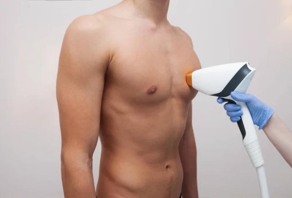 Depilación láser para hombres (1)