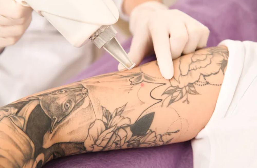Eliminación de tatuajes con láser (1)