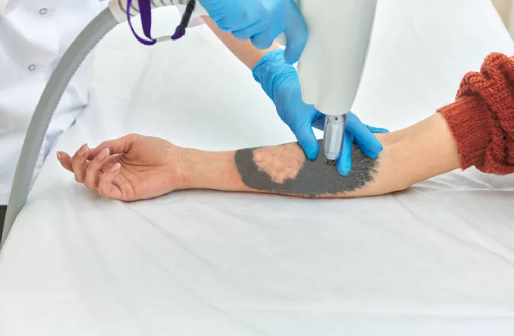 Eliminación de tatuajes con láser (2)