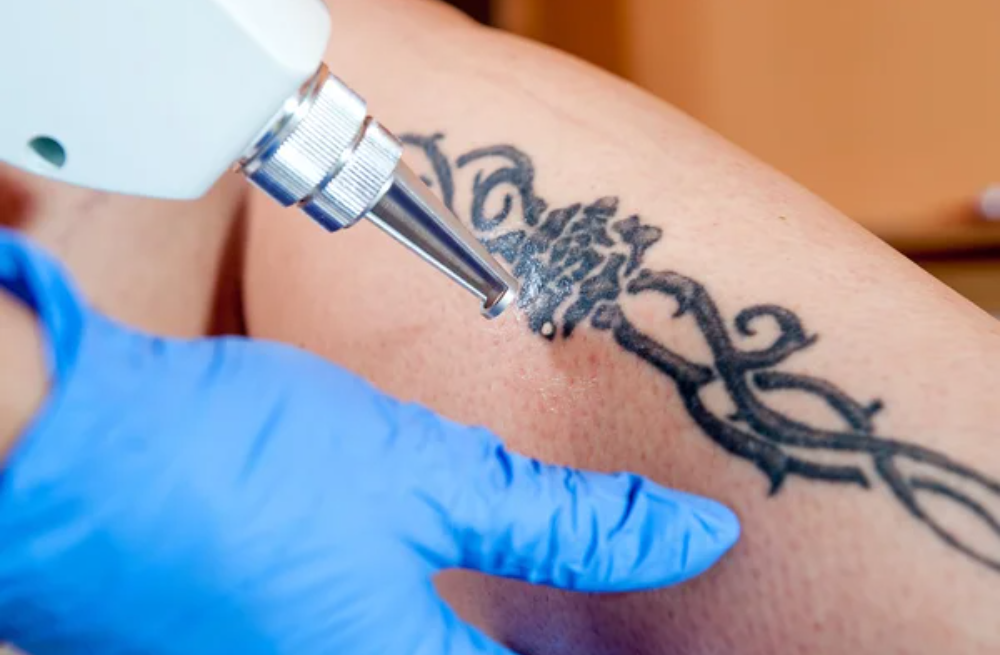 Eliminación de tatuajes con láser (5)
