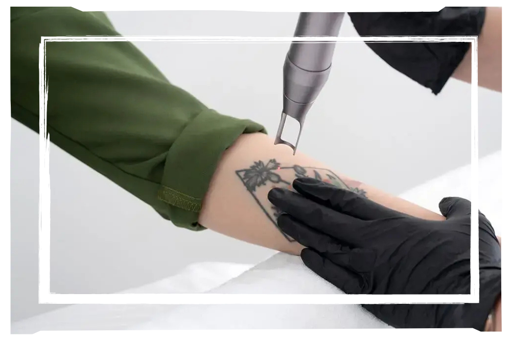 Laser Tattoo Removal