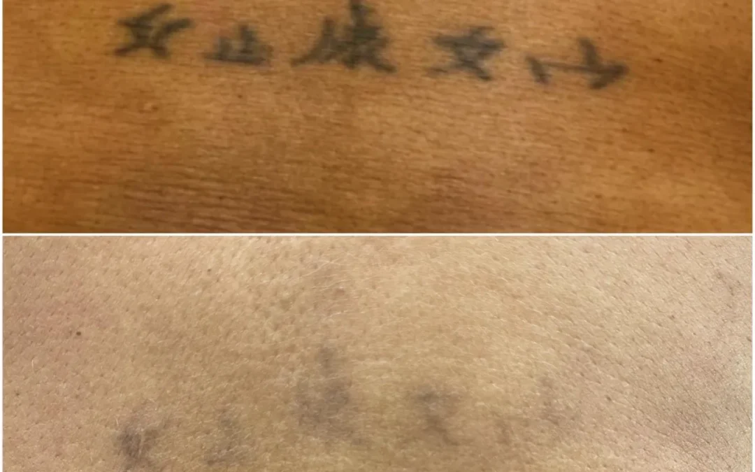 4 Reasons to Remove a Tattoo