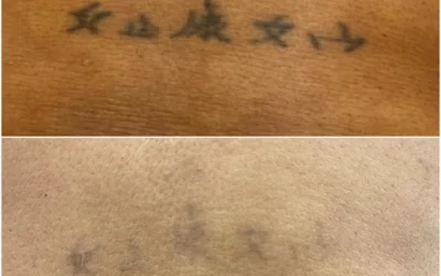 4 Reasons to Remove a Tattoo