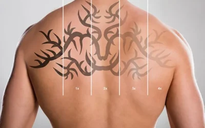 Why Tattoo Removal Times Can Vary