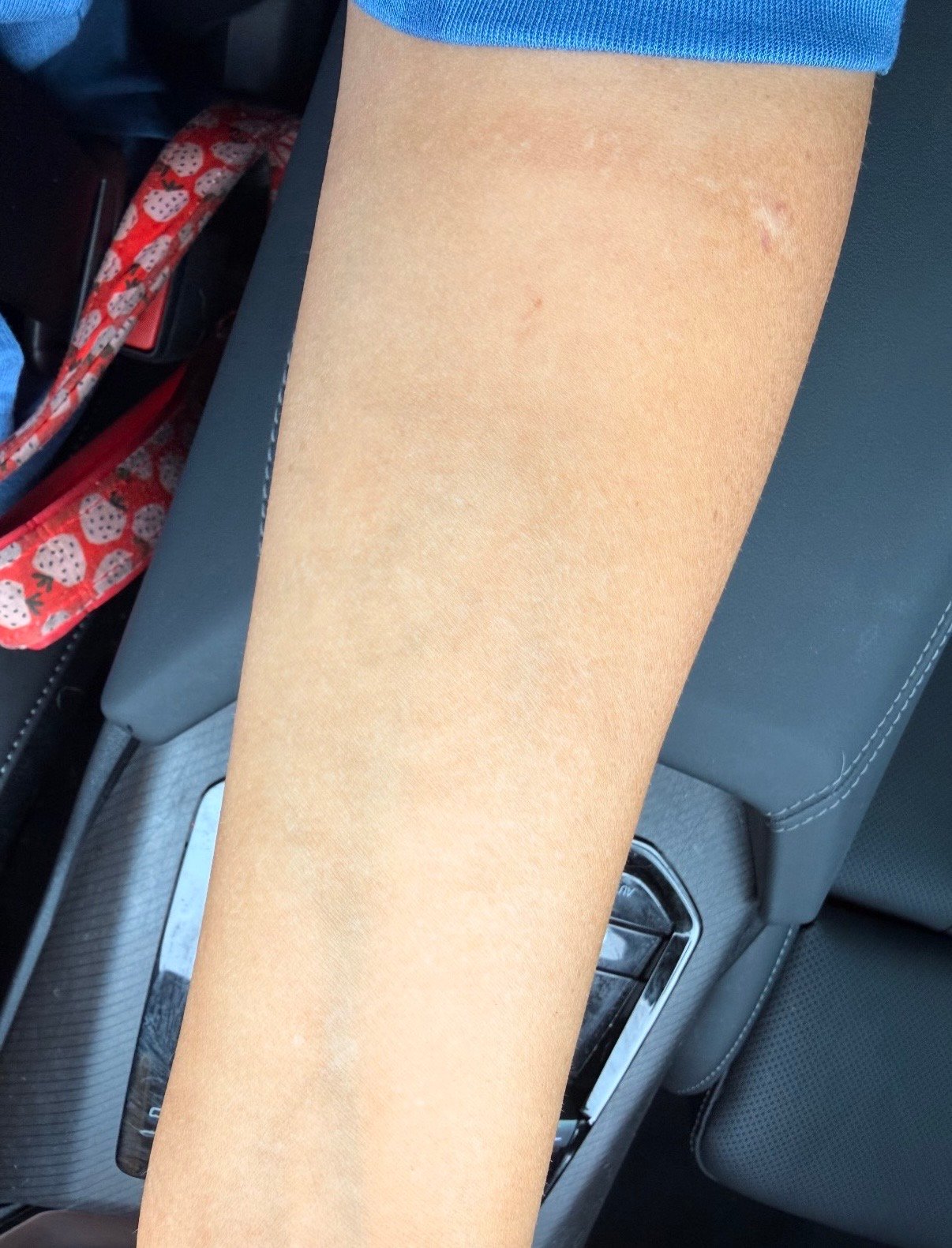Tattoo after removal treatment at Knue Laser
