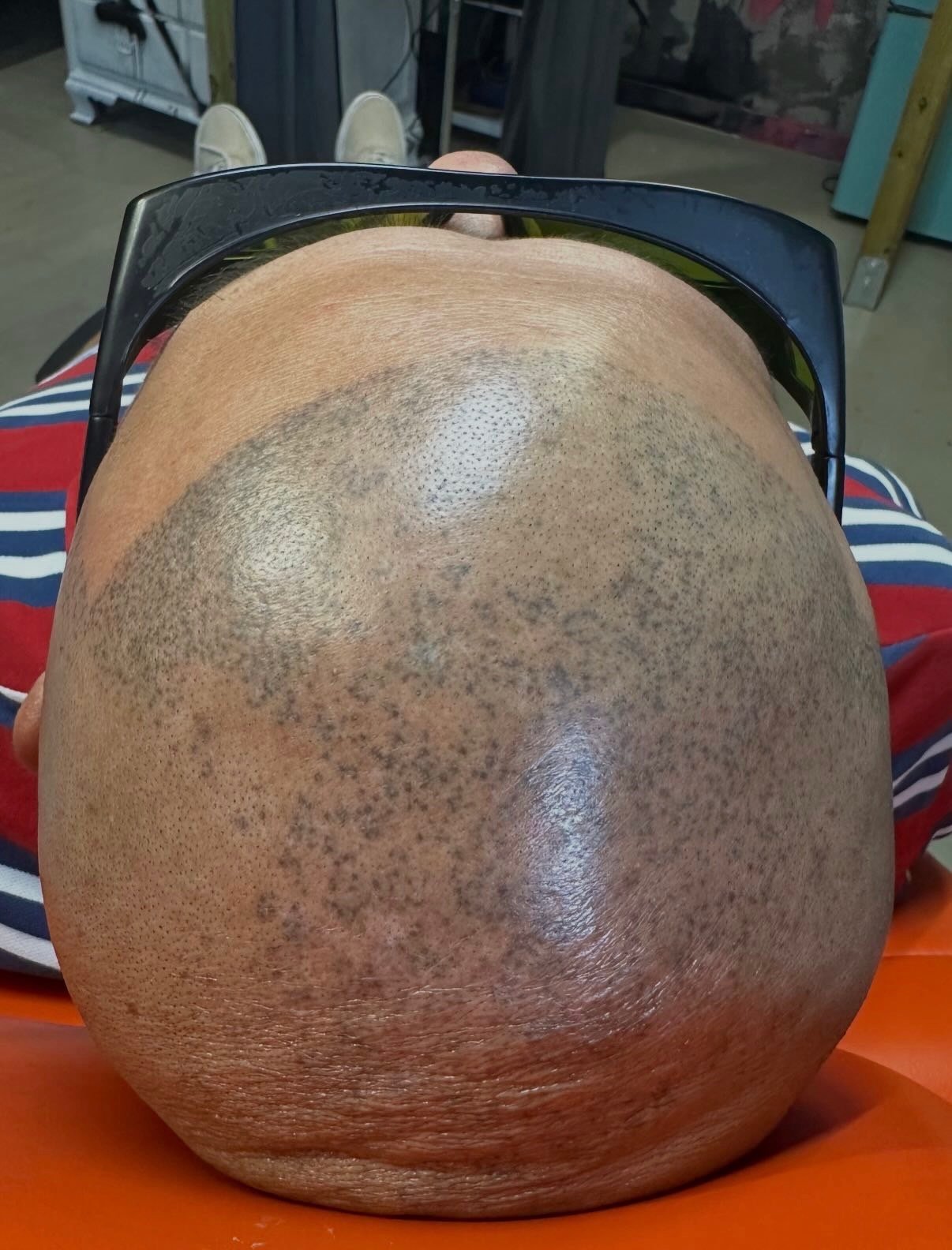 Scalp micropigmentation before removal treatment at Knue Laser