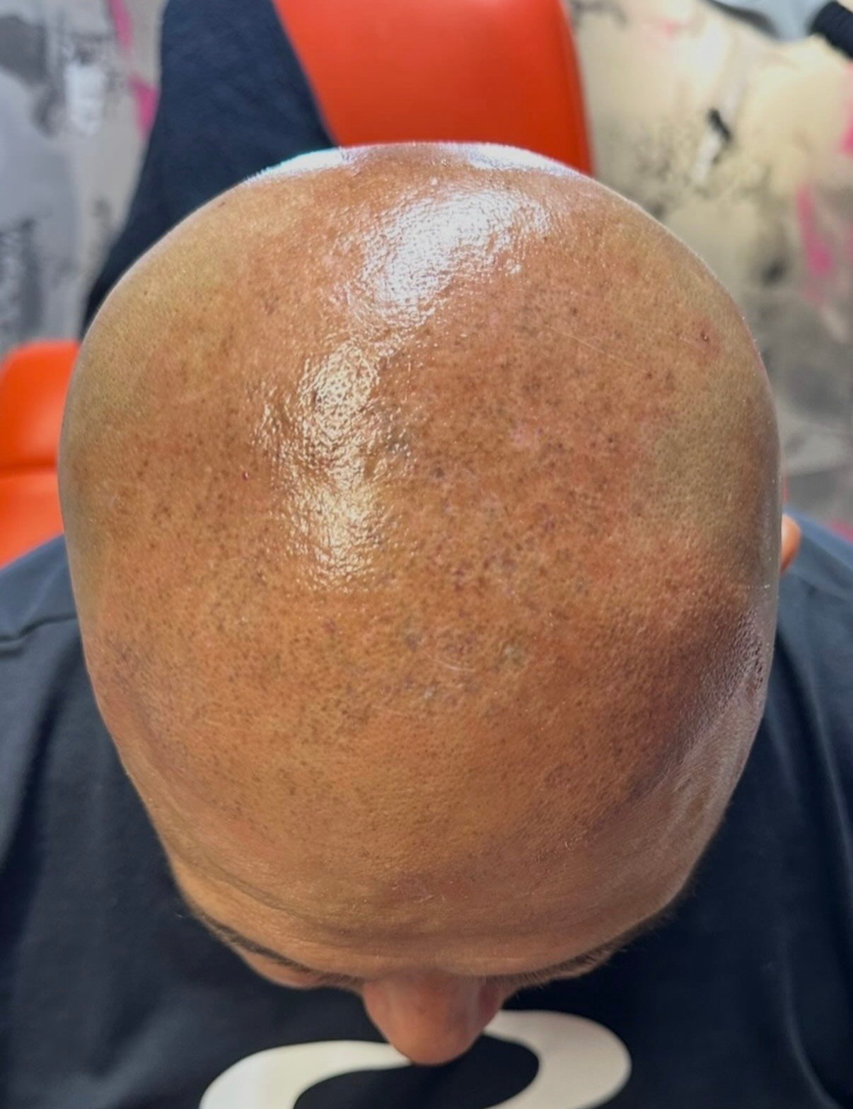 Scalp micropigmentation after removal treatment at Knue Laser